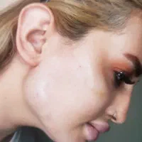 تزریق ژل