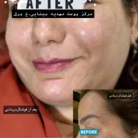 فیشال تخصصی و درمانی با برند کلینیکی کره جنوبی|خدمات آرایشگری و زیبایی|بندر کنگان, |دیوار