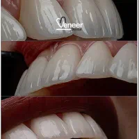 دندانپزشکی کامپوزیت ( واحدی ۸۹۰ هزار)لمینت ایمپلنت