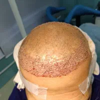 کاشت مو با قیمت استثنایی