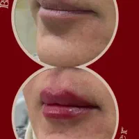 ژل /بوتاکس/مزوتراپی تخفیف ویژه عیدانه