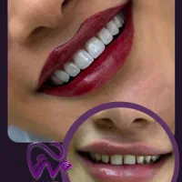 کامپوزیت دندان/لیرینگ/لمینت «اقساط»|خدمات آرایشگری و زیبایی|تهران, تجریش|دیوار