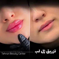 کاشت مو و ابرو/بوتاکس/بلفاروپلاستی/رفع غبغب/اقساطی