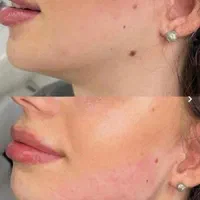 تزریق ژل لب ب روش روسی آنباکسش توسط زیباجو|خدمات آرایشگری و زیبایی|مشهد, پنجتن|دیوار