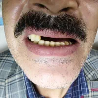 دندانسازی بی واسطه دندان مصنوعی ژله ای نرم و راحت