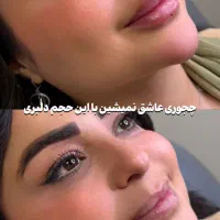 تزریق لب روسی/فیلر بادی/بوتاکس/مزوژل/prp|خدمات آرایشگری و زیبایی|تهران, تهرانپارس غربی|دیوار