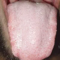 درمان کل بیماری هاازطریق زبان