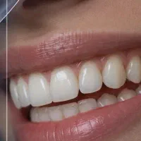 ایمپانت لمینیت روکش ترمیمی عصب کشی