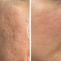 آموزش آلگاپیل (تکنیک پوست مار)|خدمات آموزشی|لنجان, |دیوار