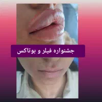 فیلر و بوتاکس|خدمات آرایشگری و زیبایی|ارومیه, |دیوار