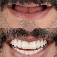 ایمپلنت یک روزه با 9.700