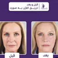 کلاژن تراپی صورت جهت رفع چروک صورت و افتادگی پوست