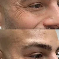 تزریق ژل و بوتاکس|خدمات آرایشگری و زیبایی|بابل, |دیوار