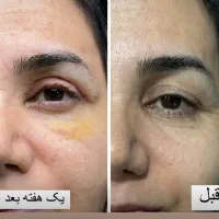 جشنوراه جراحی پلک بالا بلفاروپلاستی|خدمات آرایشگری و زیبایی|اصفهان, خانه اصفهان|دیوار