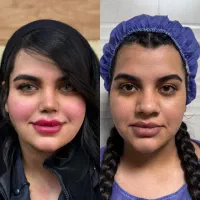 جراحی بینی با قیمت پارسال + مشاوره رایگان