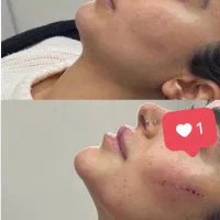 تزریق ژل و بوتاکس|خدمات آرایشگری و زیبایی|بروجرد, |دیوار