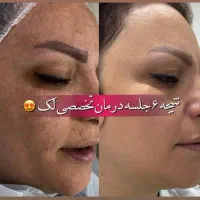 لیزرموهای زائد وپلاژن ترابی ویژه بانوان|خدمات آرایشگری و زیبایی|مشهد, توس (بلوار توس)|دیوار