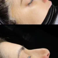 جراحی بینی شاهرود