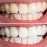 سفید کردن دندان|خدمات آرایشگری و زیبایی|رشت, دیلمان|دیوار