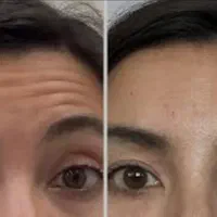 تزریق فیلر و بوتاکس مزوتراپی و جوانساز