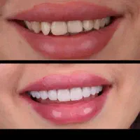 افر ویژه کامپوزیت دندان مواد تضمینی و اصلی|خدمات آرایشگری و زیبایی|کرج, گوهردشت|دیوار