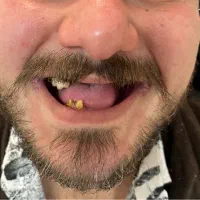 دندان مصنوعی + دندانسازی|خدمات آرایشگری و زیبایی|تهران, شمشیری|دیوار