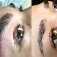 انجام تخصصی فیبرو و میکروبلیدینک وشیدلب