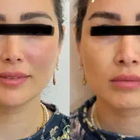 تزریق فیلر و بوتاکس و ترمیم با کمترین هزینه|خدمات زیبایی و سلامت|تهران, ایران|دیوار