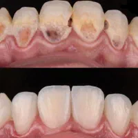 کامپوزیت ایمپلنت ارتودنسی بندرعباس|خدمات آرایشگری و زیبایی|بندرعباس, |دیوار