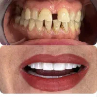 عصب کشی اقساطی|خدمات زیبایی و سلامت|اصفهان, عطار نیشابوری|دیوار