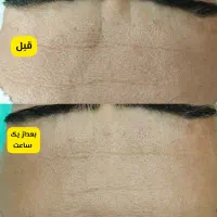 فیشال پاکسازی پوست آقایان فیشیال تخصصی کلینیک قم|خدمات آرایشگری و زیبایی|قم, دورشهر|دیوار