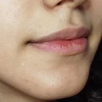 فیلر لب نچرال|خدمات آرایشگری و زیبایی|رشت, بلوار گیلان|دیوار