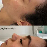 پاکسازی و فیشیال تخصصی و پلاژن تراپی ( فیشال )|خدمات آرایشگری و زیبایی|شیراز, شهرک قمشه|دیوار