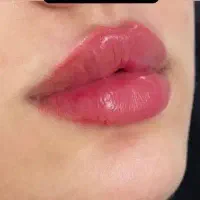 آموزش تزریقات زیبایی توسط پزشک