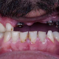 دندانپزشکی ایمپلنت کامپوزیت لمینیت روکش دندان|خدمات آرایشگری و زیبایی|تبریز, |دیوار