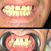 ساخت دندان مصنوعی اقتصادی با خدمات در منزل|خدمات آرایشگری و زیبایی|ری, دیلمان|دیوار