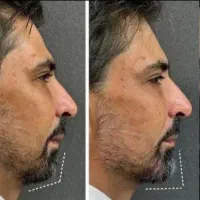 ژل و بوتاکس|خدمات آرایشگری و زیبایی|دورود, |دیوار