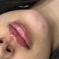 آموزش ژل و بوتاکس