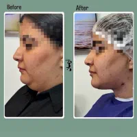 جشنواره ی لیپوساکشن غبغب و بوکال فت توسط پزشک