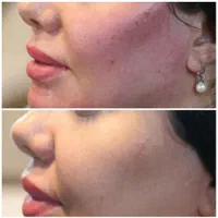 تزریق فول فیس صورت،فیلر لب وزاویه سازی