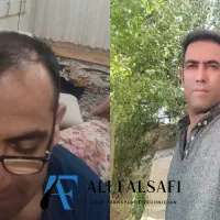 کاشت مو طبیعی و پرتراکم