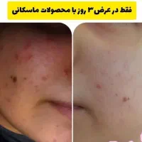 درمان تخصصی جوش های صورت|آرایشی، بهداشتی، درمانی|کرج, شهرک آسمان|دیوار