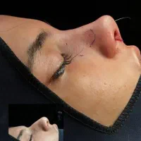 آف  ویژه زیبایی بینی