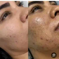 فیشیال و پاکسازی وجوانسازی پوست