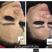 فیشیال تخصصی پوست آقایان و خانم ها