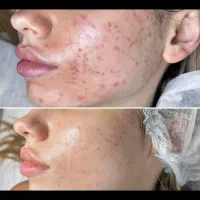 جوانسازی ،درمان پوست ،فیشال،پاکسازی،پوست کره ای|خدمات آرایشگری و زیبایی|شیراز, قدوسی غربی|دیوار