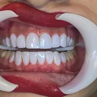 کامپوزیت دندان .۰لیرینگ .لمینت .ونیر|خدمات آرایشگری و زیبایی|ری, تقی آباد|دیوار