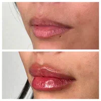 تزریق ژل بوتاکس مزو جوانساز|خدمات آرایشگری و زیبایی|وحیدیه, |دیوار
