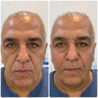 فیلر ‌بوتاکس ژل لب روسی کانتورینگ|خدمات آرایشگری و زیبایی|تهران, جمهوری|دیوار