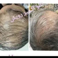 محلول و درمان رشد موی سر کاملا گیاهی|آرایشی، بهداشتی، درمانی|مهاباد (آذربایجان غربی), |دیوار